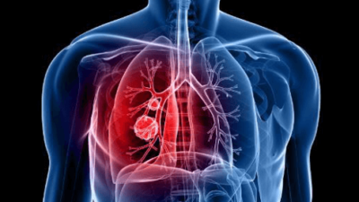 an illustration of lung cancer